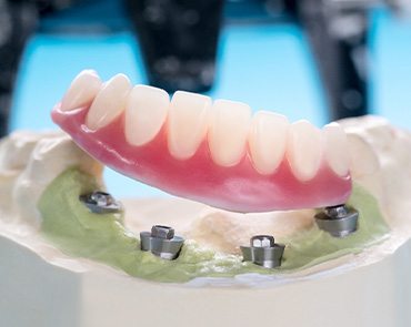 Denture and implant model on tray in Ponte Vedra Beach
