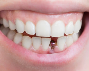 Patient smiling to reveal their dental implant post