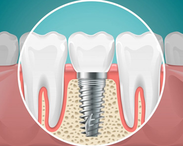 Graphic of a dental implant fused with bone material 