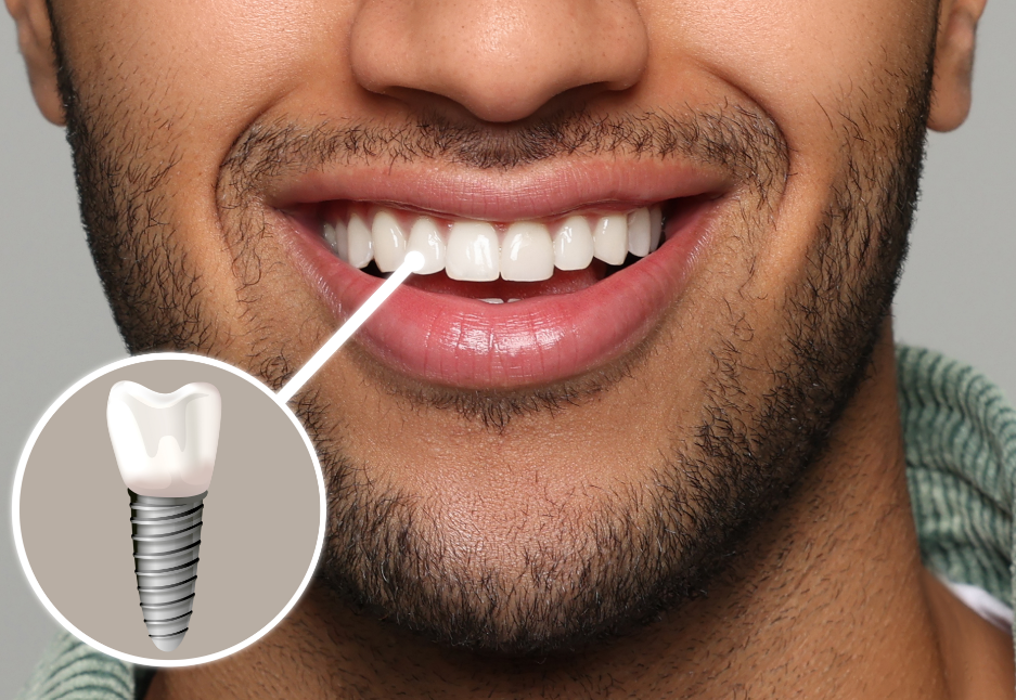 Close up of man's smile with dental implant