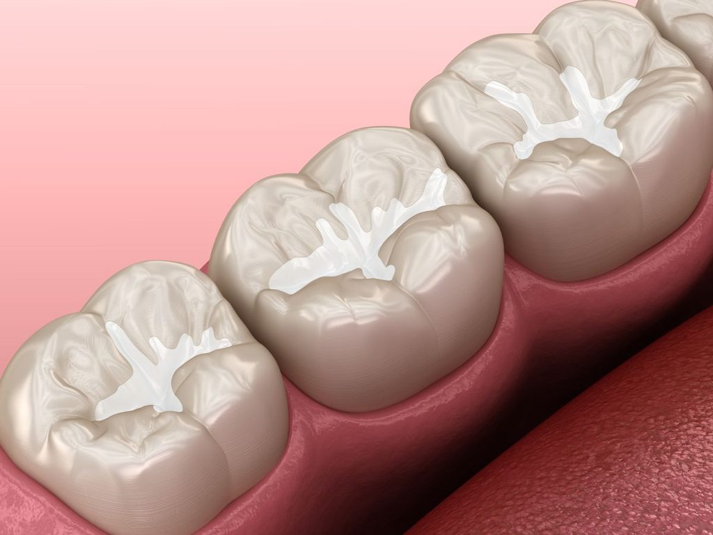 A CGI of teeth with composite resin fillings